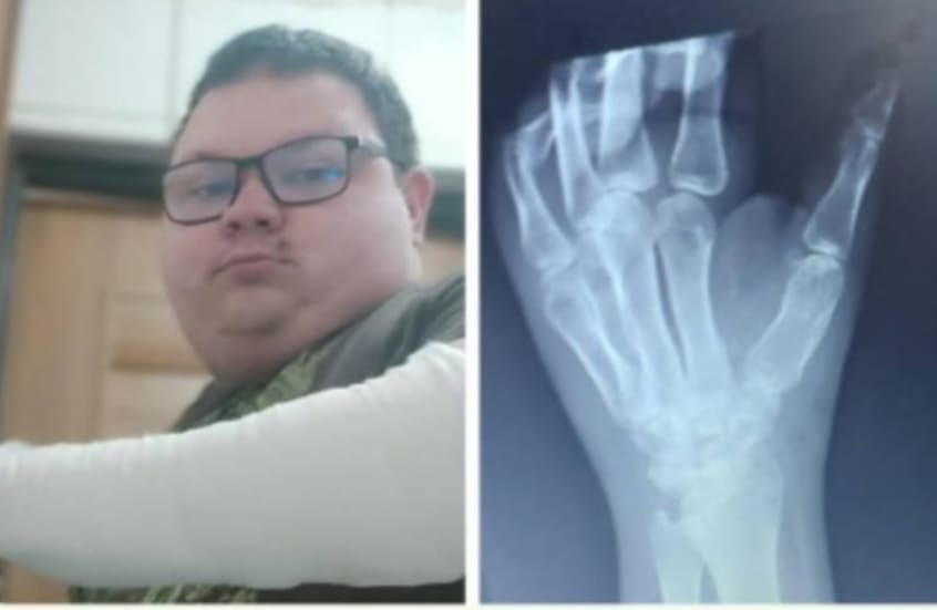 "Chcę jeszcze zaznać trochę euforii zanim odejdę". Wielkopolanin cierpi na niezwykle rzadką chorobę. Jego kości pękają w szybkim tempie