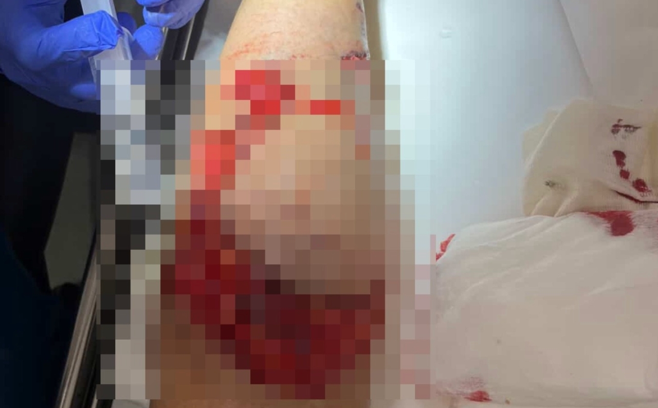 Amstaff pogryzł kobietę na Boninie. Jest zbiórka na leczenie